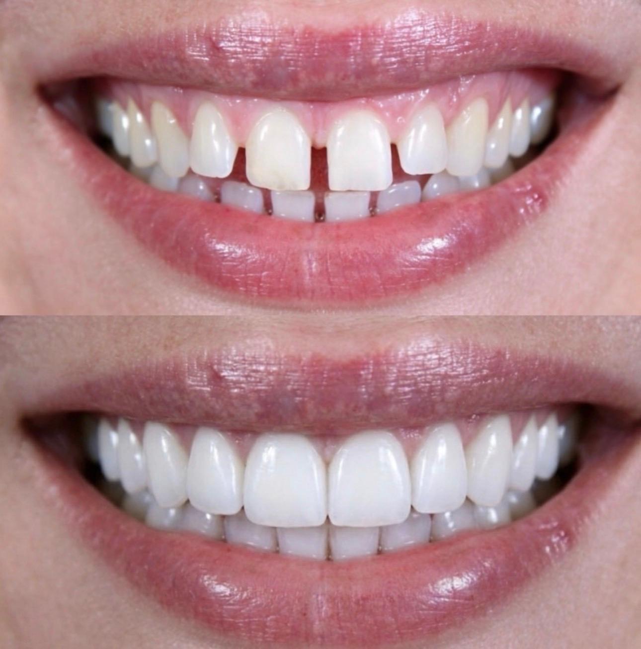 Hasta gülüş dönüşümü 5