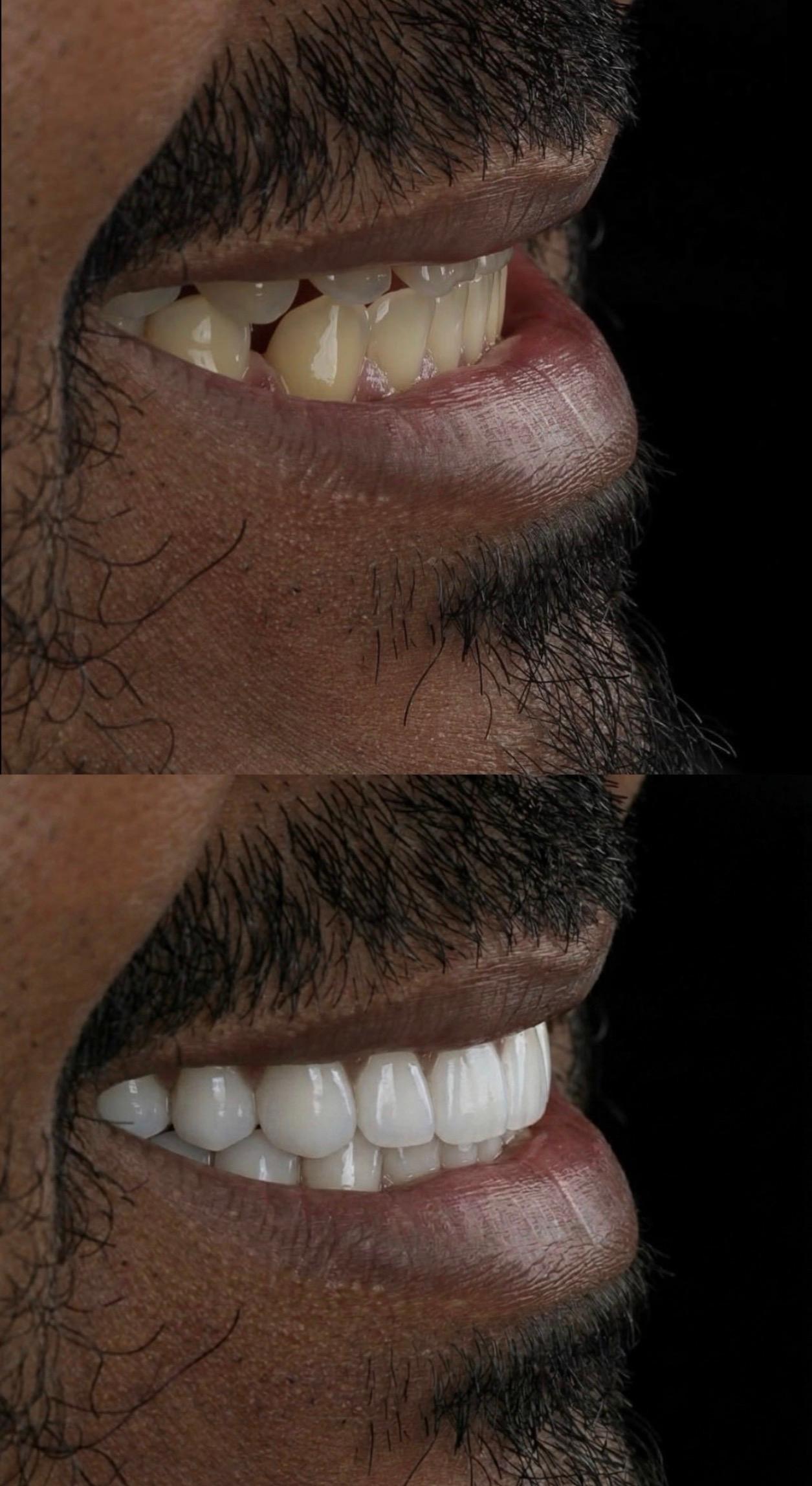 Hasta gülüş dönüşümü 7