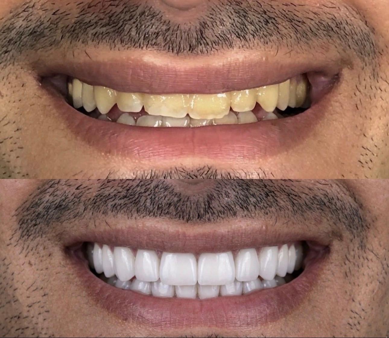 Hasta gülüş dönüşümü 8