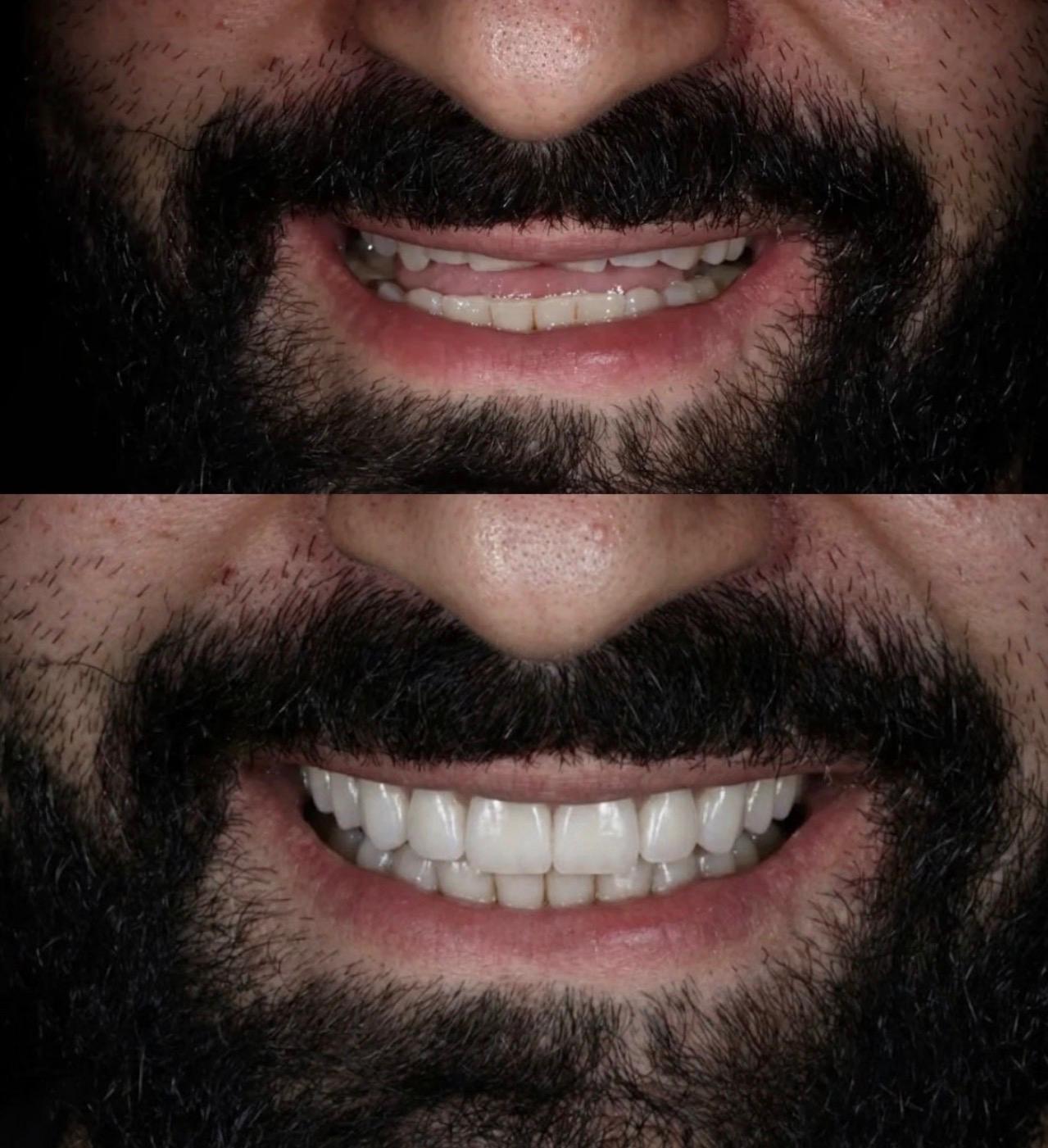 Hasta gülüş dönüşümü 11