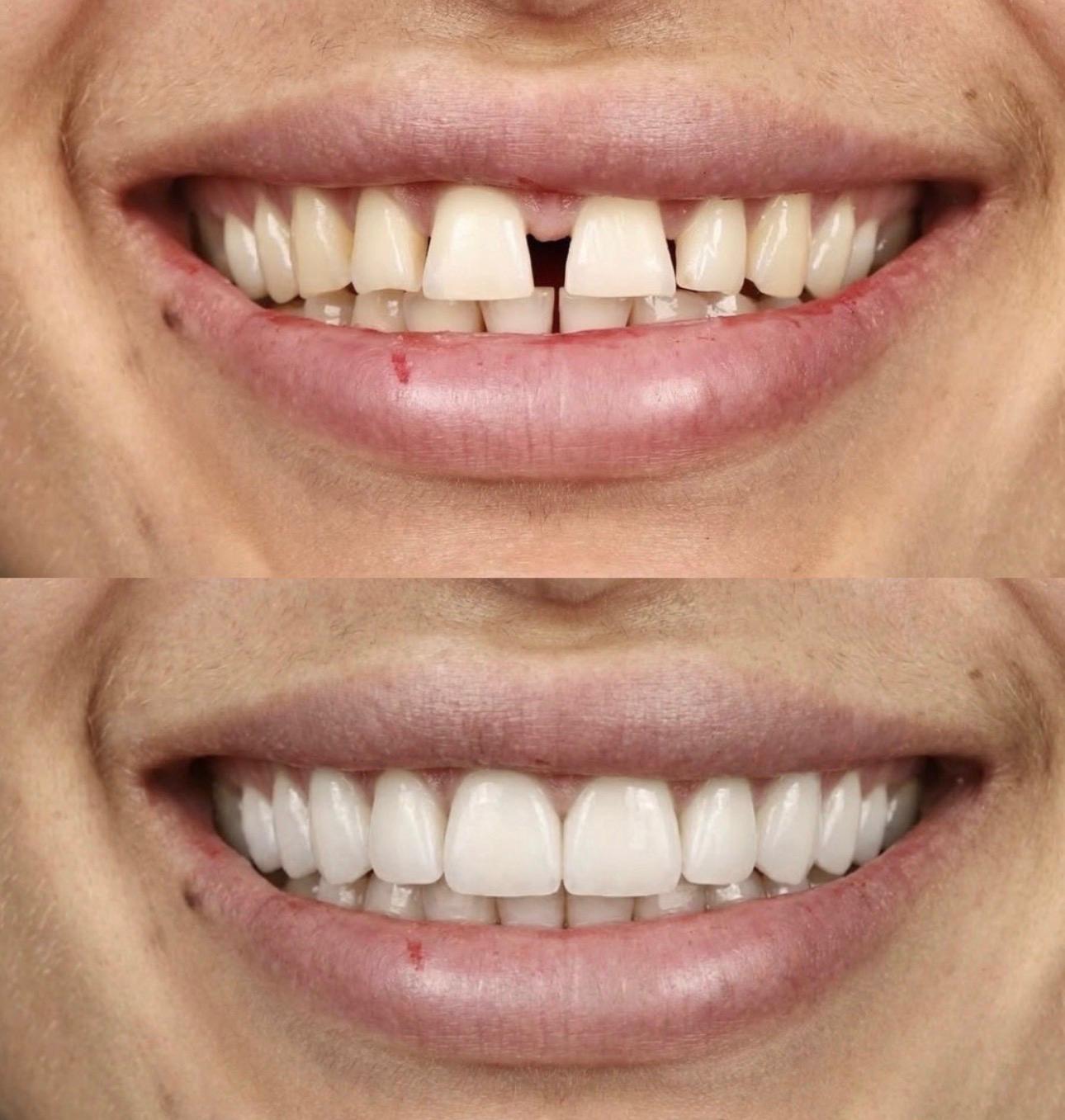 Hasta gülüş dönüşümü 13