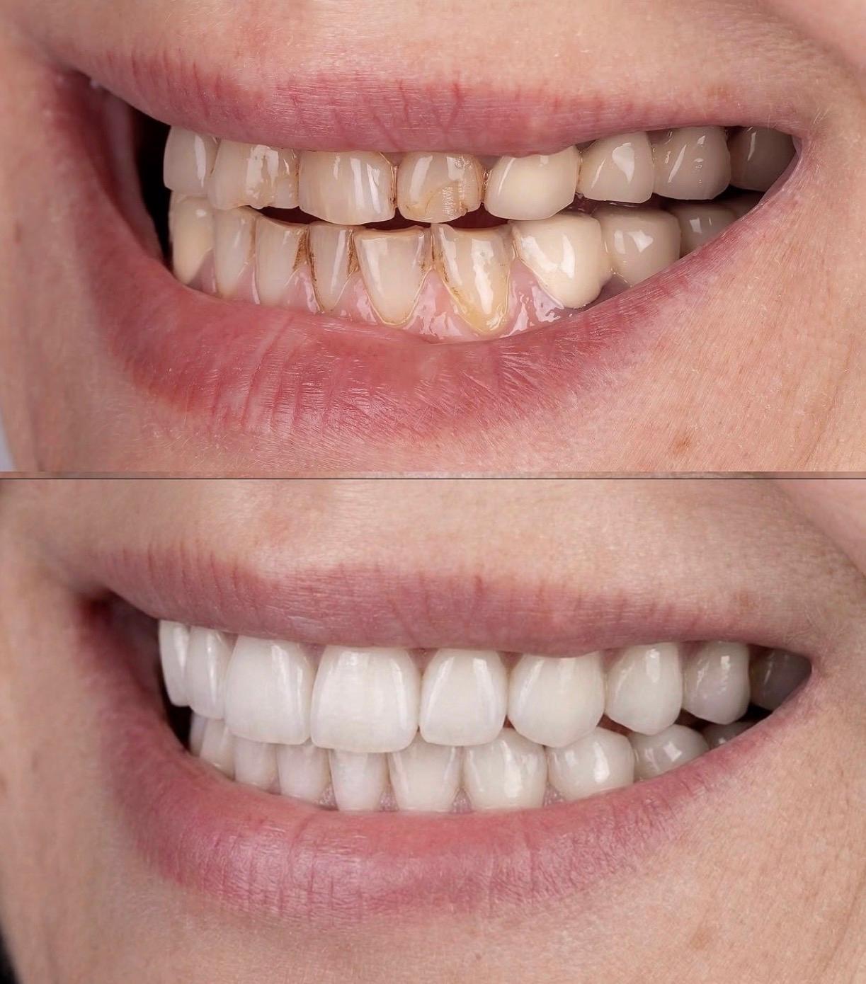 Hasta gülüş dönüşümü 16