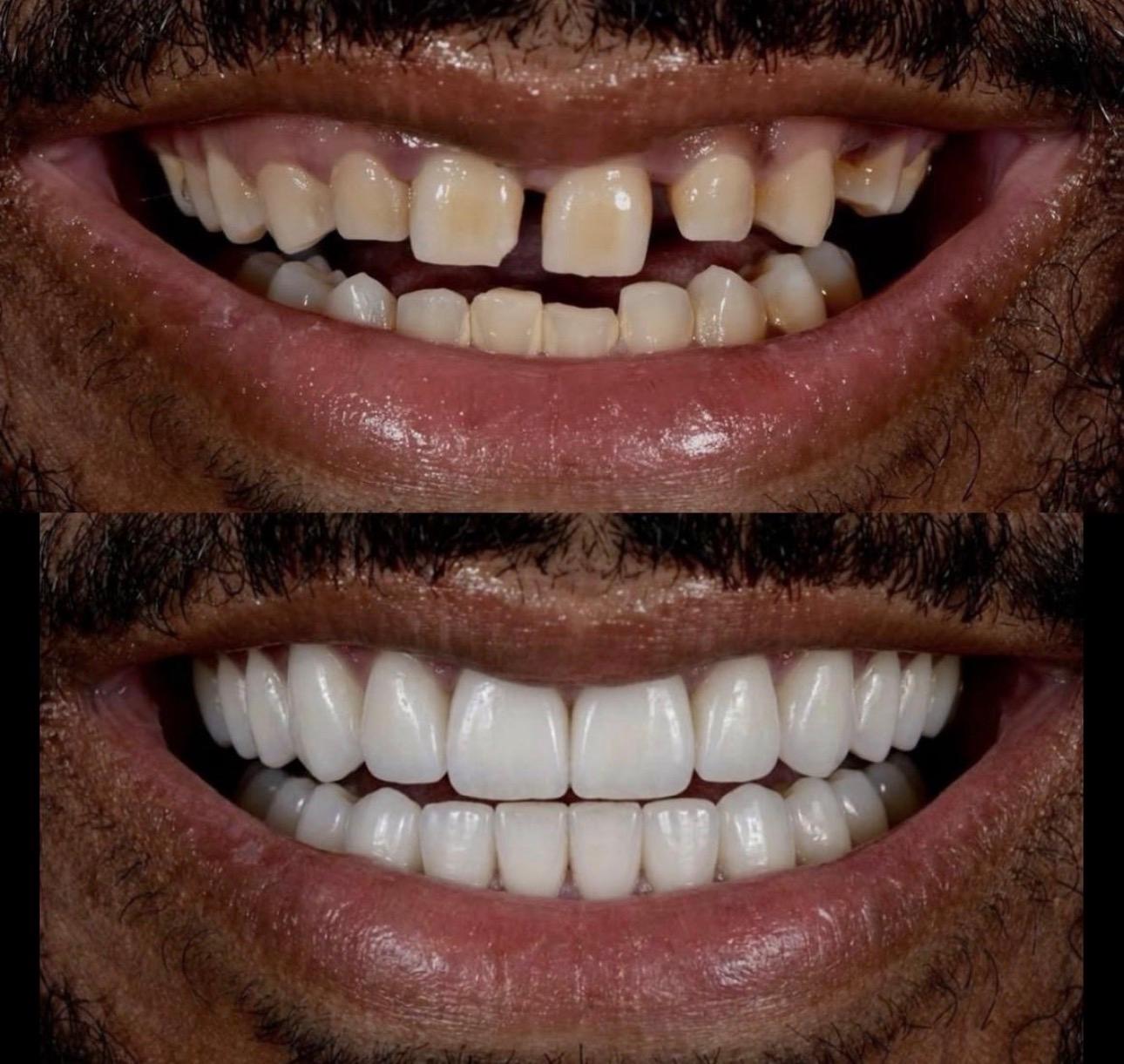 Hasta gülüş dönüşümü 19