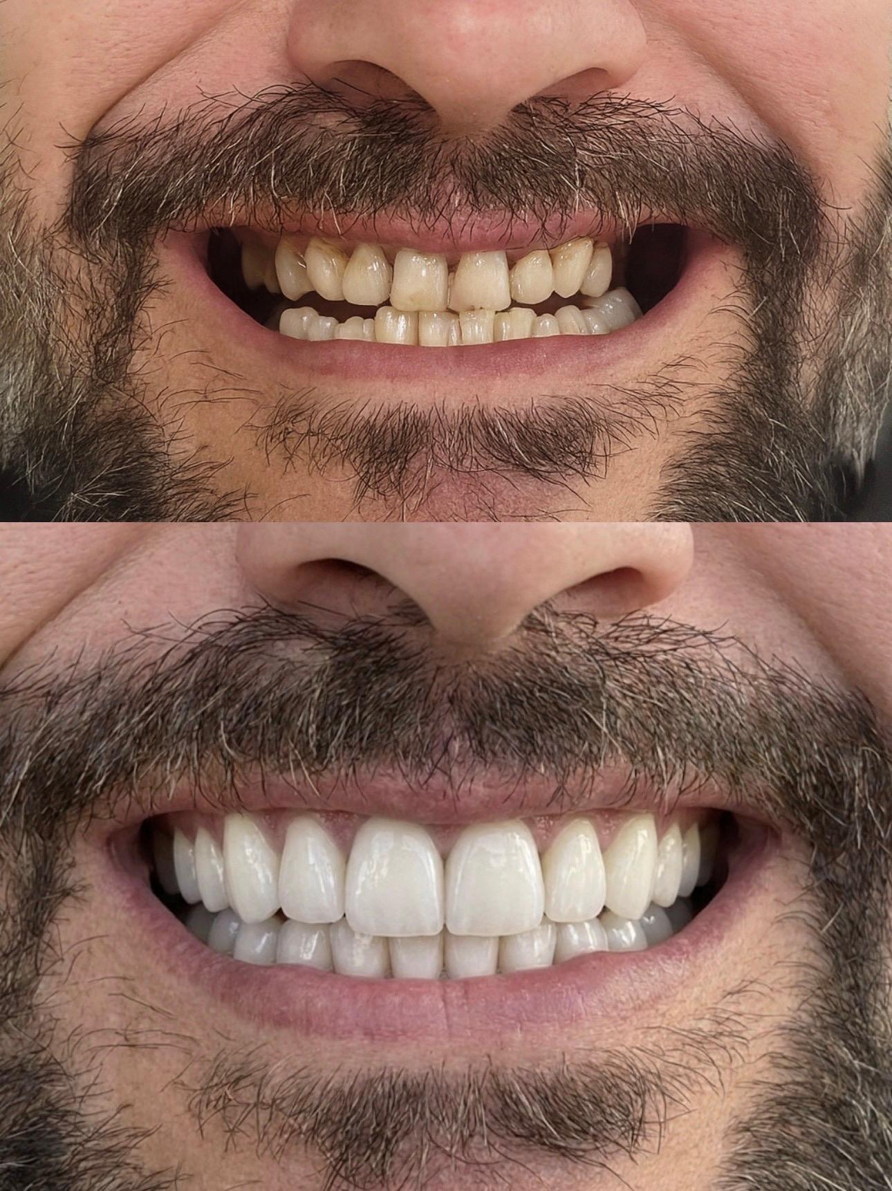 Hasta gülüş dönüşümü 28